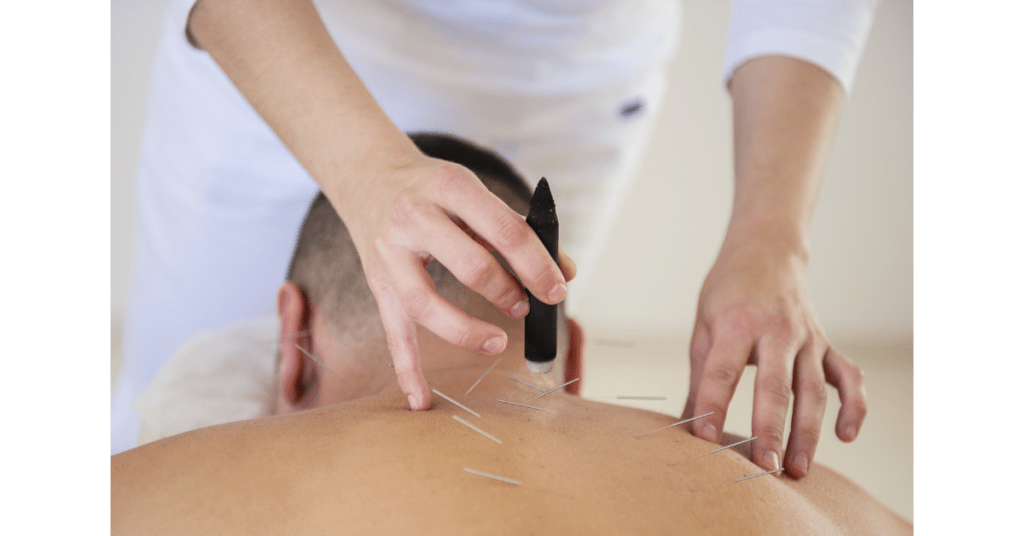 acupuncture_Simply-Align-Rehab-Physiotheraphy-Scarborough-Toronto
