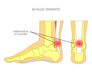 achilles-tendonitis-physiotherapy