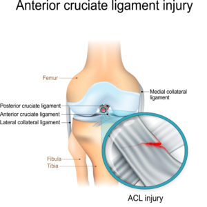 Anterior-cruciate-Ligament-Injury-physio-treatment-toronto