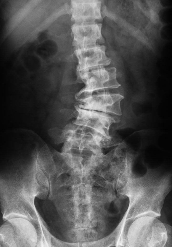 X-ray image of lumbo-sacral spine (L-S spine) showing lumbar spondylosis disease, AP view