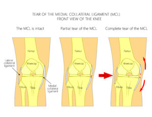 Medial Collateral Ligament Injury physio treatment toronto