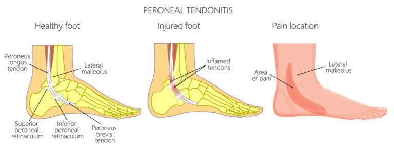 Physiotherapy For Peroneal Tendonitis-Scarborough