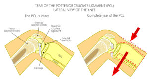 Posterior Cruciate Ligament Injury physio treatment toronto