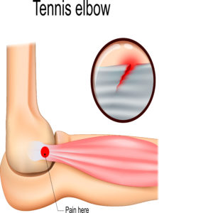 Tennis-elbow-or-lateral-epicondylitis-physiotherapy-in-toronto