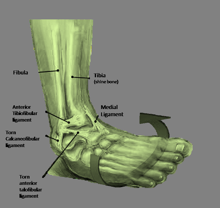 ankle-sprain-treatment-scarborough-toronto