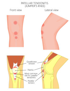 patellar-tendonitis-or-jumper-knee-physio-treatment