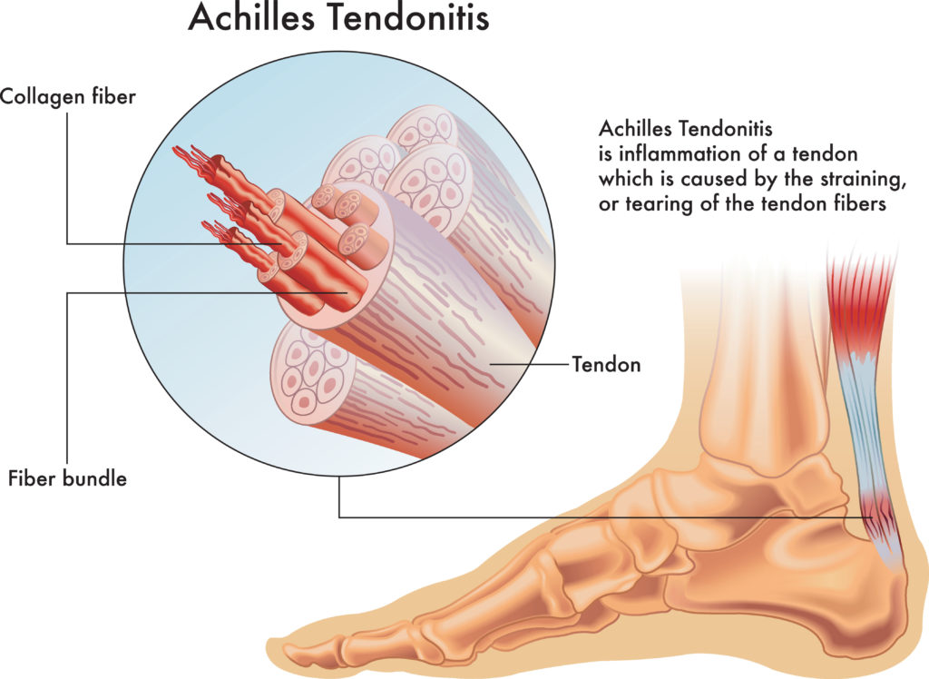 How To Play Football With Achilles Tendonitis