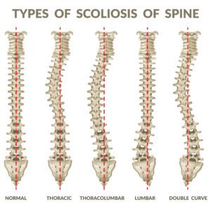 types of scoliosis of spine image