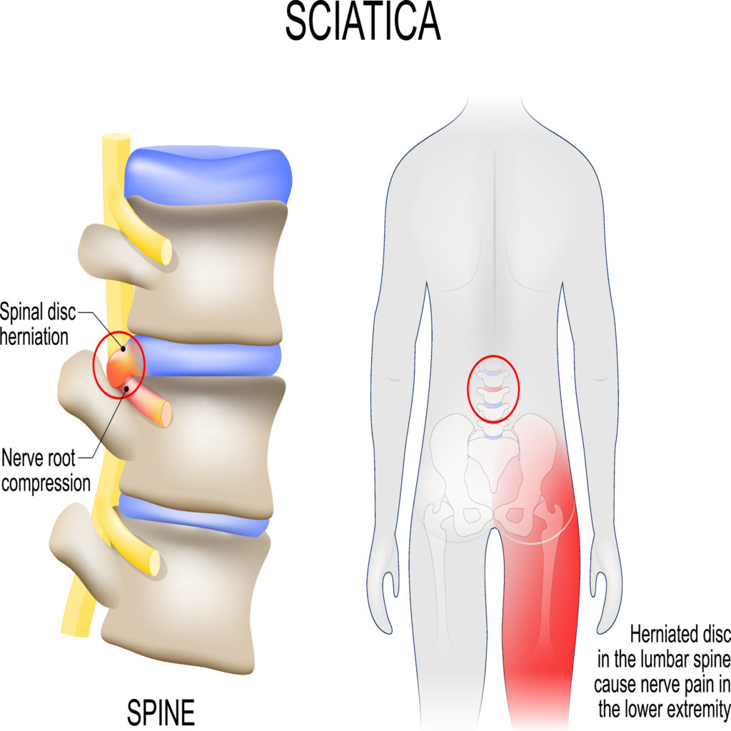 nerve study on lower back