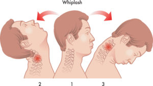 whiplash-physiotherapy-tornto