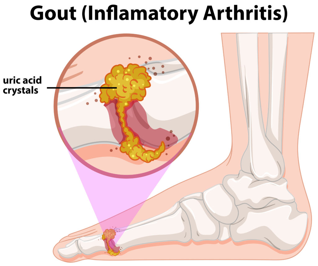 Get Physio & Chiro Treatment For Gout | Simply Align Rehab