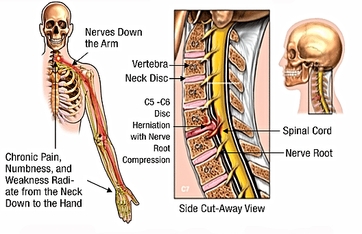 Cervical disc hernation picture -showing pain going down the arm 